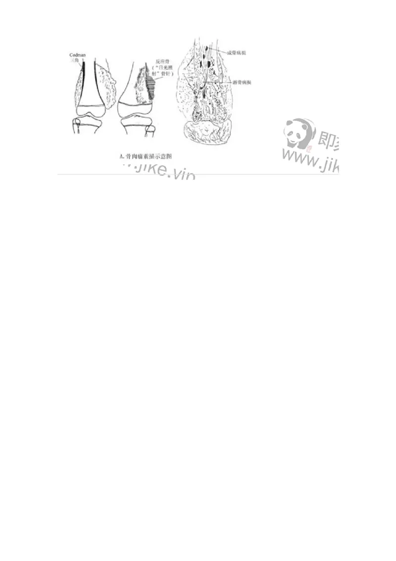 20333-第三十三单元骨肿瘤-174709_军队文职(1)_01.军队文职真题-专业课_（全）版本一（历年真题+章节练习+模拟题）_临床医学(军队文职)_预测模拟_题目+解析
