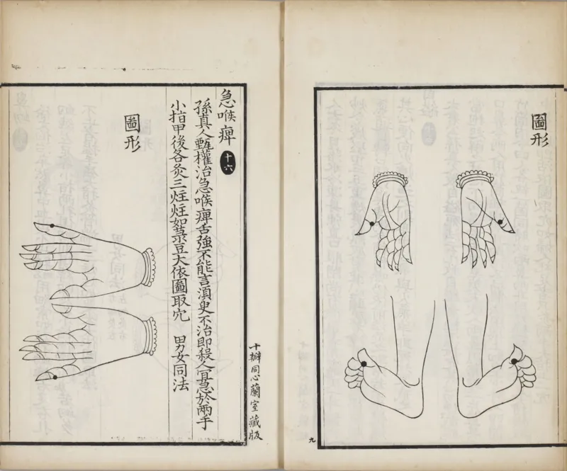 备急灸方.一卷.南宋.闻人耆年.撰.上杭罗氏十瓣同心兰室藏版.清光绪十六年影宋刊本(1)_绝版书_天涯系列_t涯_绝版古籍电子书合集（13大类）_医书类